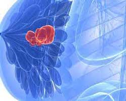 درمان قطعی سرطان سینه 3 روش اصلی درمان سرطان سینه