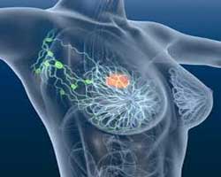 سن سرطان سینه سرطان سینه در زنان زیر 40 سال