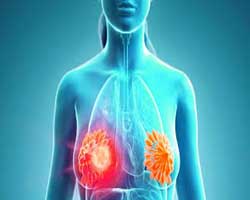 علائم سرطان سینه بدخیم علائم و نشانه های سرطان پستان
