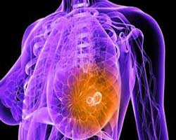 علائم سرطان سینه نشانه های هشدار دهنده ابتلا به سرطان