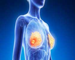 علایم سرطان سینه چیست و درمان سرطان سینه به چه شکل است؟