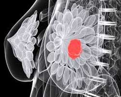گرید سرطان سینه اهمیت پاتولوژی سرطان سینه