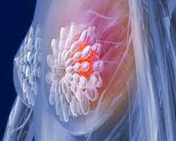 درمان سرطان سینه در مراحل اولیه آیا می توان سرطان سینه را درمان کرد؟