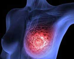 سرطان سینه چیست؛ انواع، علت و علائم سرطان پستان