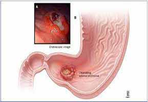 دکتر سرطان معده در آپادانا