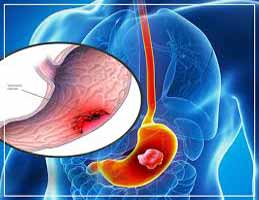 دکتر سرطان معده در خرم رودی