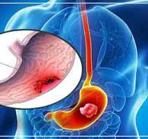 دکتر سرطان معده در دزاشیب