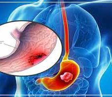 دکتر سرطان معده در دزاشیب