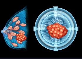 توعية سرطان الثدي - ثيمات سرطان الثدي - تفسير حلم سرطان الثدي للعزباء - تشخيص سرطان الثدي - تجربتي مع سرطان الثدي الالتهابي - سرطان الثدي