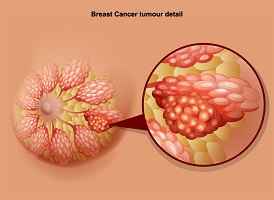 best breast cancer surgeon in louisville ky