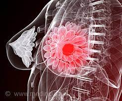 best breast cancer surgeon toronto