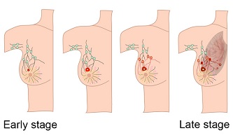 breast cancer surgeon asheville nc