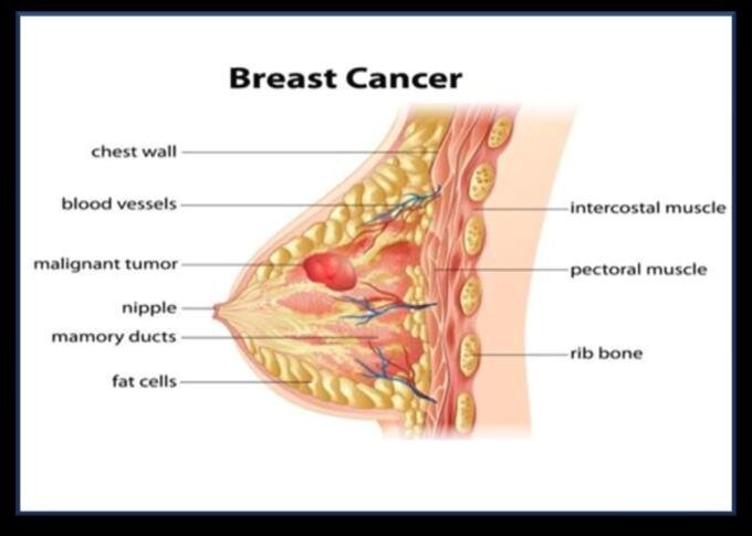 breast cancer surgeon çin