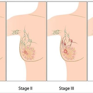 breast cancer surgeon edmonton