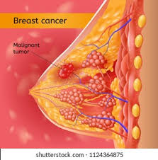 breast cancer surgeon eugene oregon