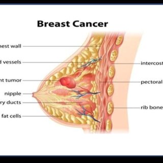 breast cancer surgeon fresno