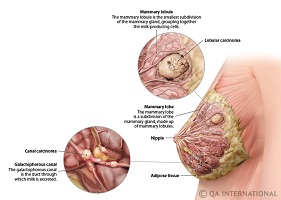 breast cancer surgeon gosford