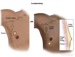 breast cancer surgeon in mumbai