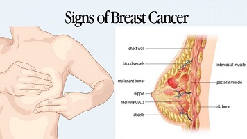 breast cancer surgeon long island