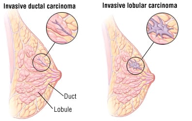 breast cancer surgeon mississauga