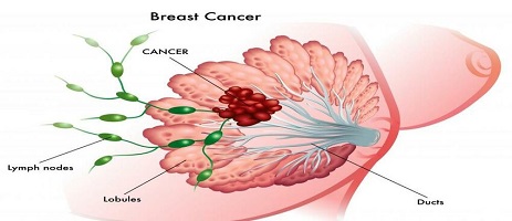 breast cancer surgeon nairobi