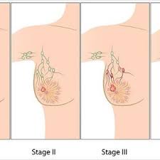 breast cancer surgeon orlando