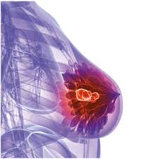 breast cancer surgeon recommendation