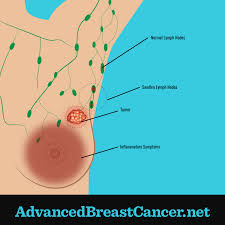 breast cancer surgeon redlands