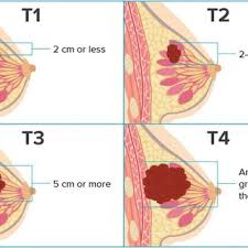 breast cancer surgeon sunshine coast