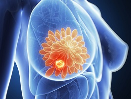 breast cancer surgeon tampa