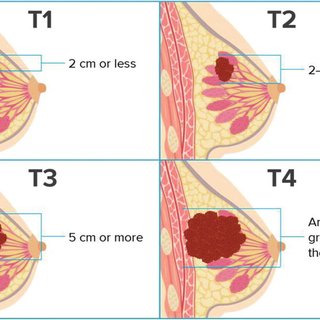 breast cancer surgeon toronto