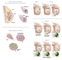 breast cancer surgeon ucsf