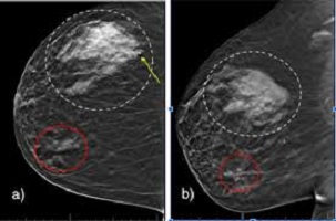 breast cancer surgeon uk