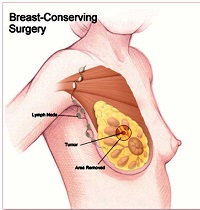 do you see a surgeon or oncologist first for breast cancer