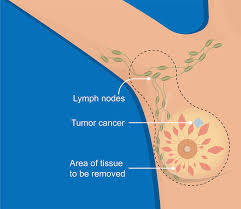 dr kamlesh verma – cancer surgeon oncologist cancer doctor cancer specialist breast specialist