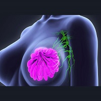 questions to ask surgeon after breast cancer diagnosis