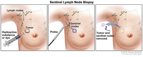 stomach cancer surgeon article