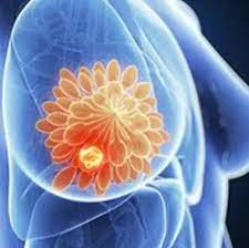 top breast cancer surgeon in mumbai