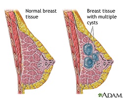 uci breast cancer surgeon