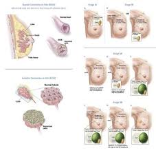 what type of surgeon does breast cancer surgery