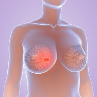 what type of surgeon removes breast cancer